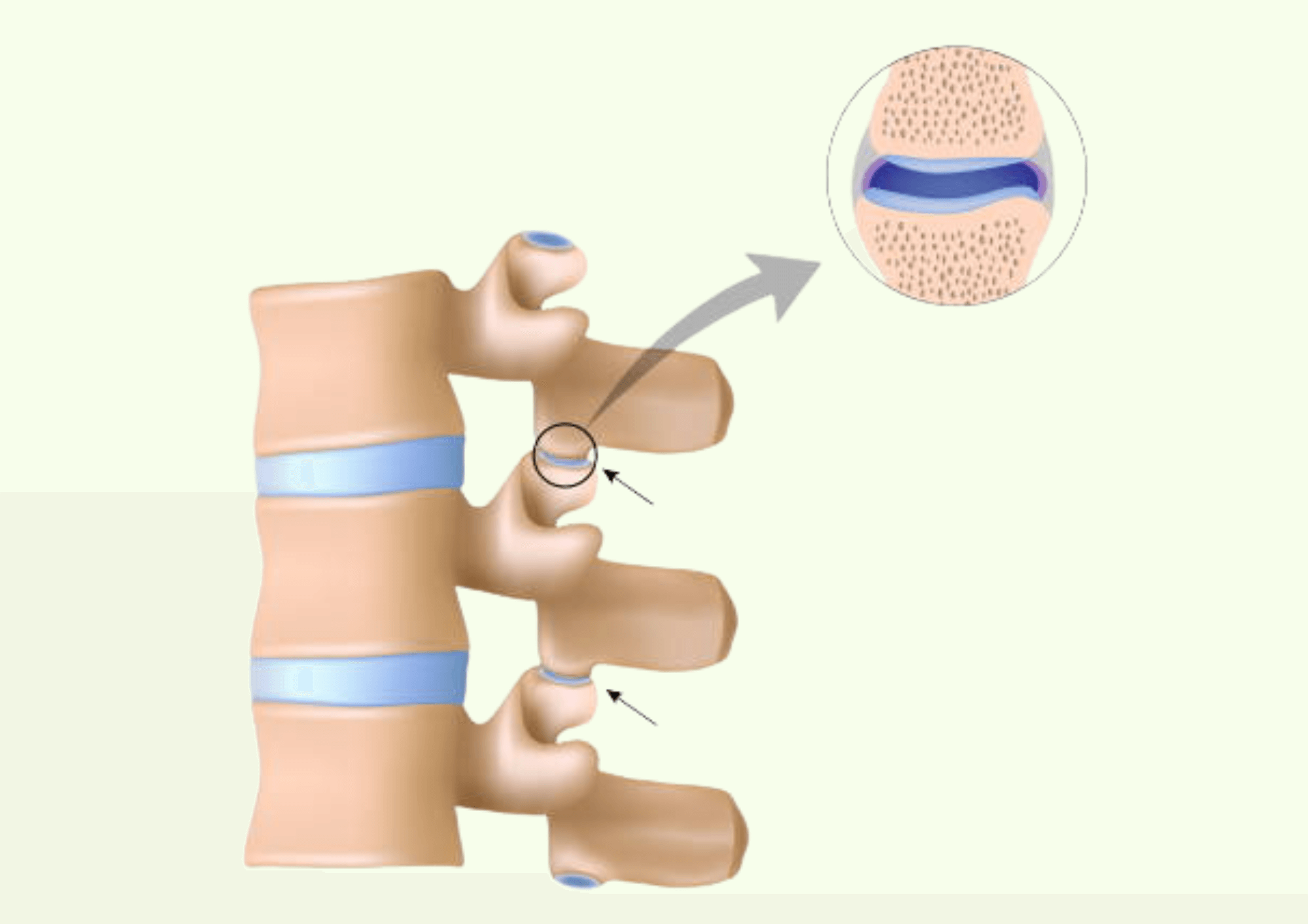 Image of spine and joints to show affected areas of spondylarthrosis.
